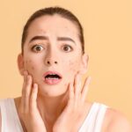 What Are the Best Tips for Reducing Acne and Breakouts?