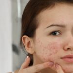 How to Treat Acne Scars and Prevent New Breakouts